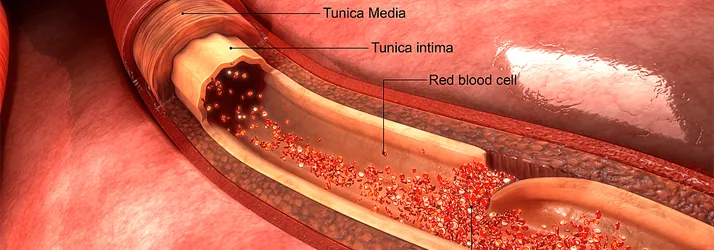 The Expert Witness Gilbert AZ Cervical Artery Dissection