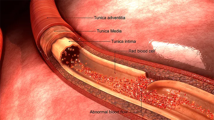 The Expert Witness Gilbert AZ Cervical Artery Dissections